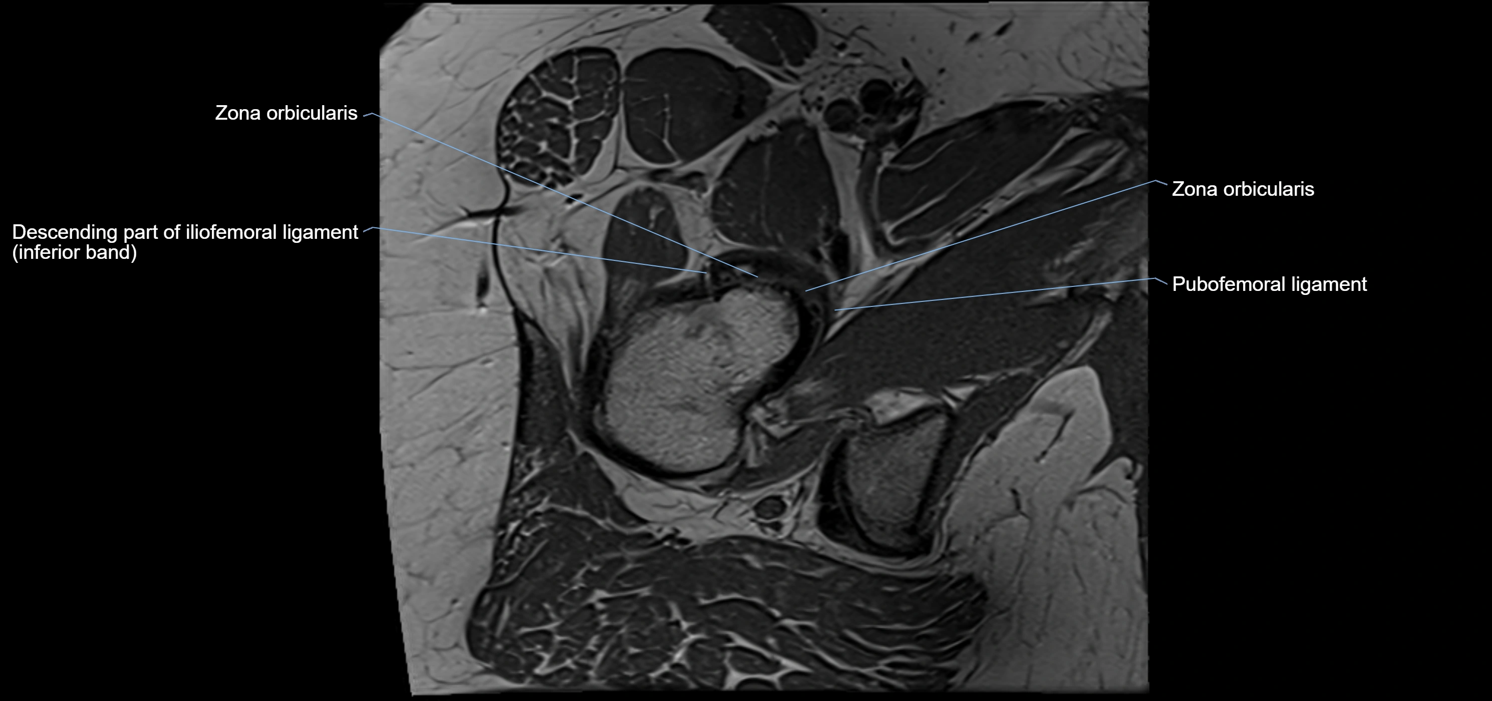 Hip ligament anatomy axial 3T MRI image -img-13001-00024.webp